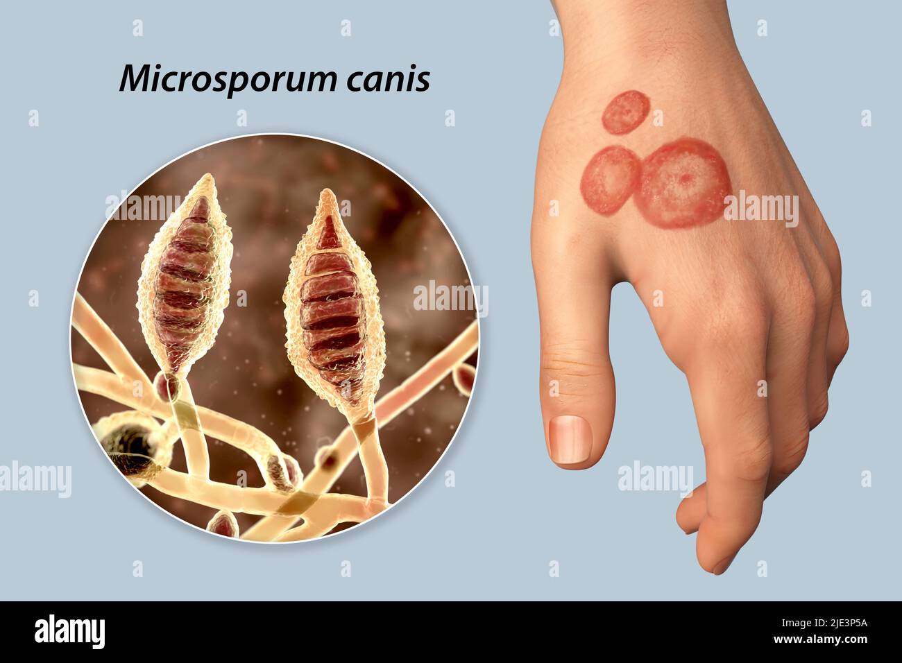 Pilzinfektion an der Hand eines Mannes, Illustration. Bekannt als Ringwurm-Infektion oder Tinea manuum. Es kann durch verschiedene Pilze, einschließlich Microsporum canis, verursacht werden. Es verursacht starken Juckreiz. Die Krankheit ist hochansteckend und kann durch direkten Kontakt oder durch Kontakt mit kontaminiertem Material verbreitet werden. Die Behandlung erfolgt mit Antimykotika. Stockfoto