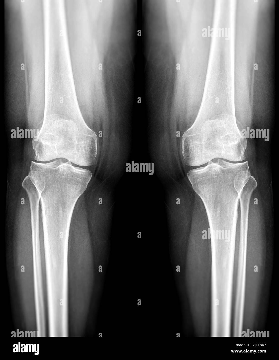 Film Röntgen beide Kniegelenk AP-Ansicht für die Diagnose Knieschmerzen von Arthrose Knie und Fraktur . Stockfoto