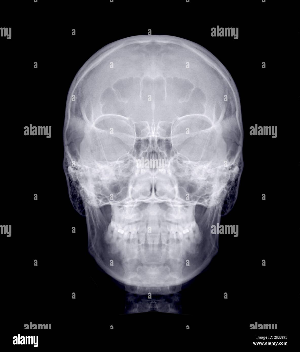 Schädel-Röntgenbild der menschlichen Vorderansicht isoliert auf schwarzem Hintergrund. Stockfoto