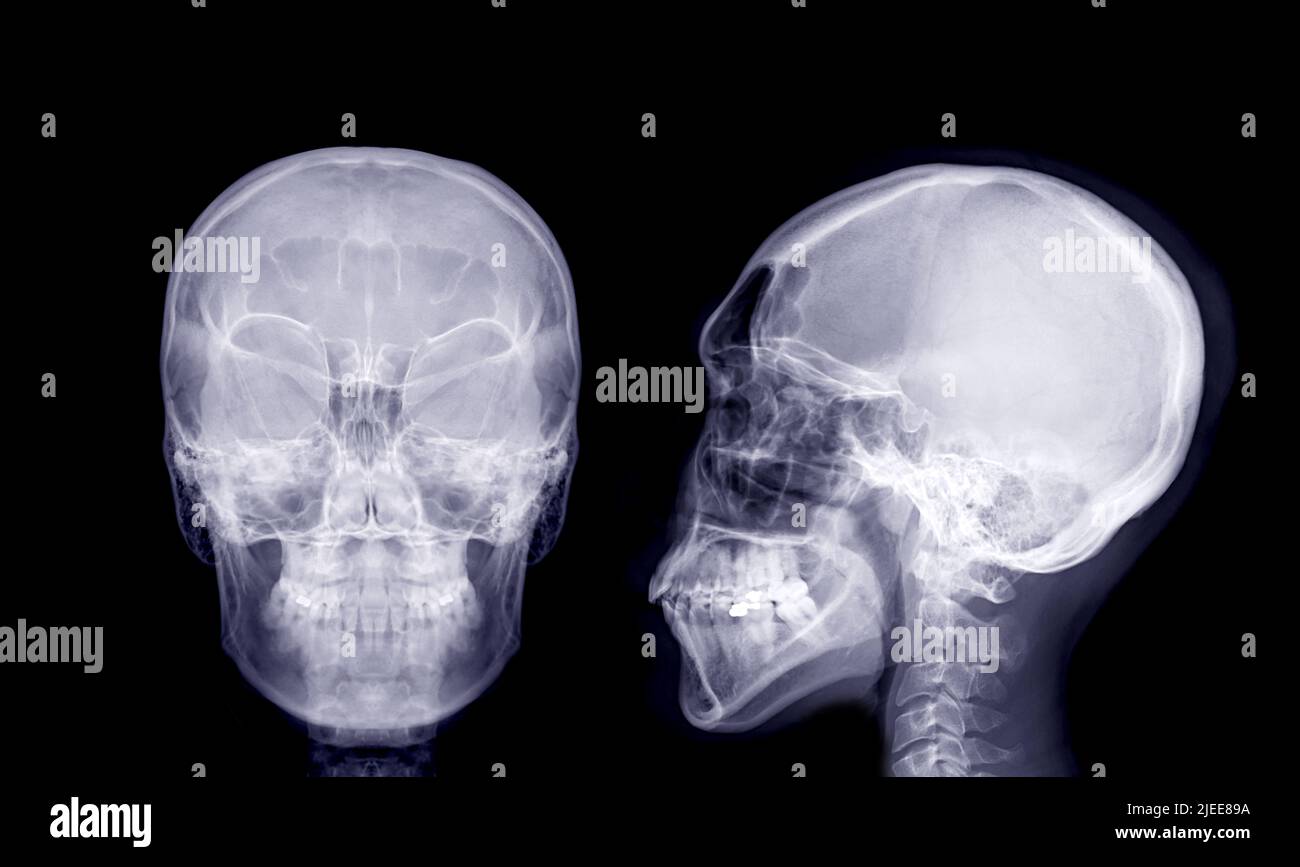 Schädel-Röntgenbild des menschlichen AP und laterale Ansicht isoliert auf schwarzem Hintergrund. Stockfoto