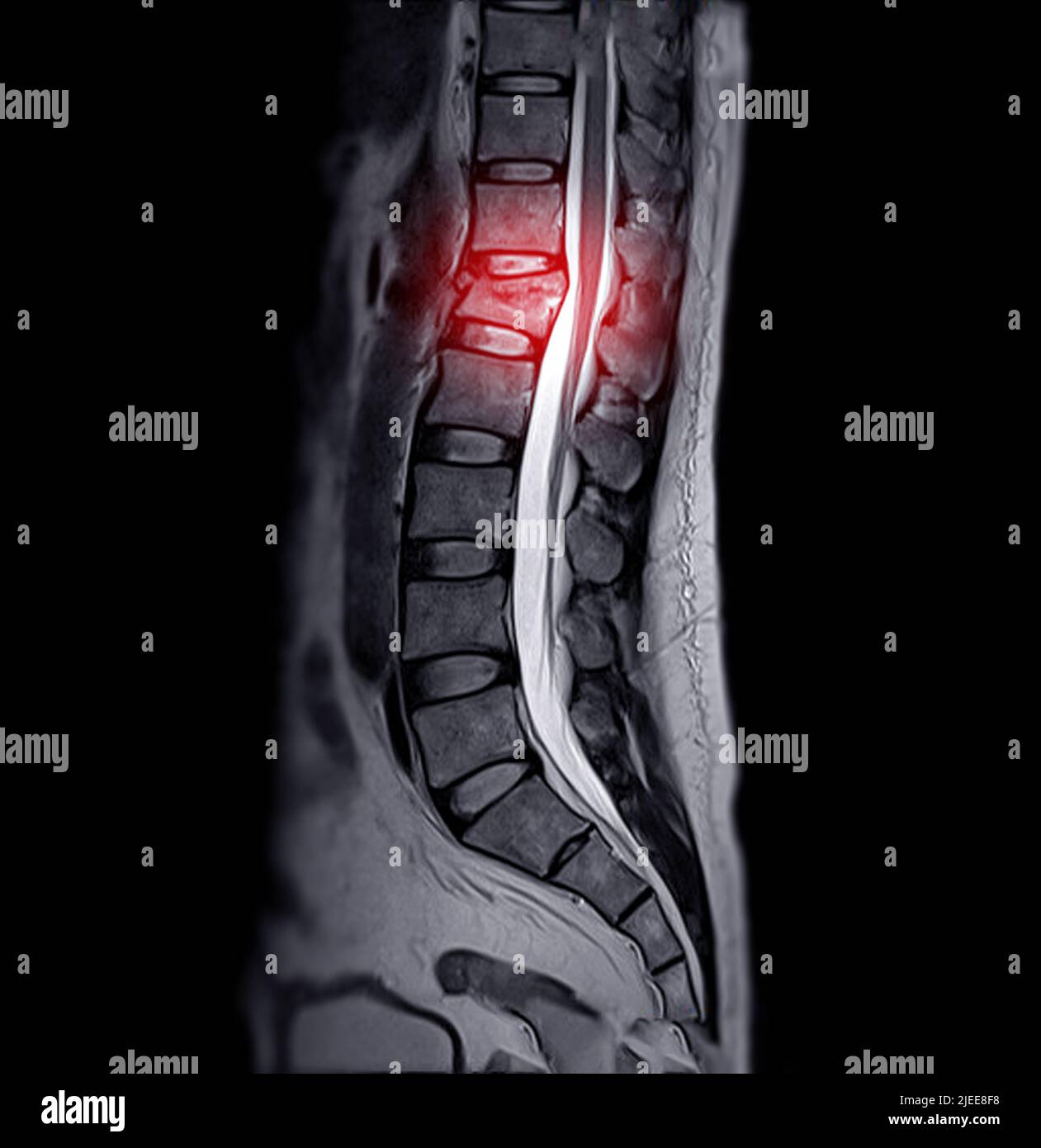 MRT der Lambosakralwirbelsäule oder der L-S-Wirbelsäule auf sagittaler Ebene mit Bandscheibenvorfall der L-S-Wirbelsäule Stockfoto