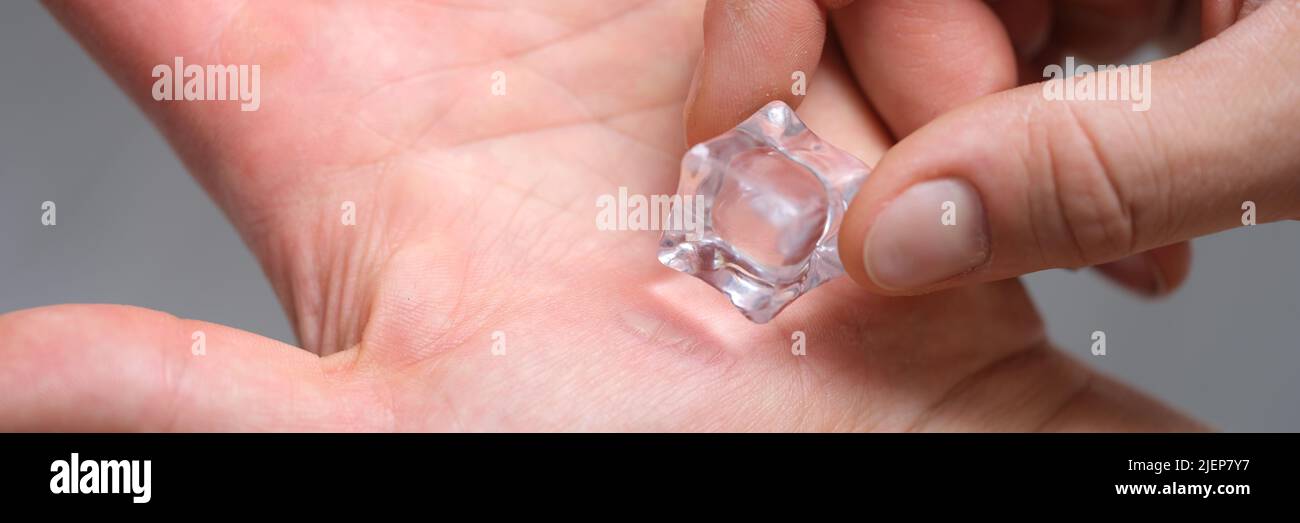 Die Hand eines Mannes reibt Schwielen mit einem Eiswürfel Stockfoto