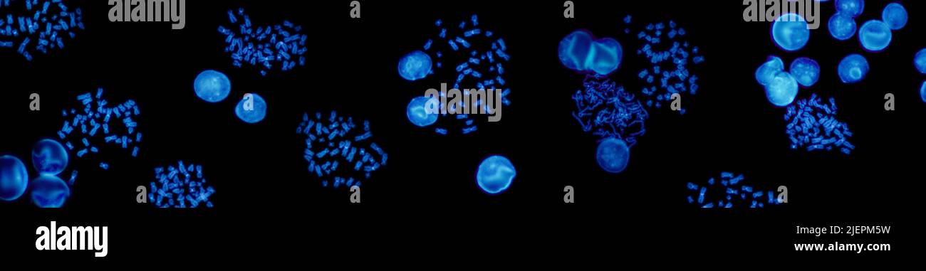 Chromosomen unter Fluoreszenzmikroskop, Fluoreszenz in situ Hybridisierungstechnik, menschliche Chromosomen aus Blut Stockfoto