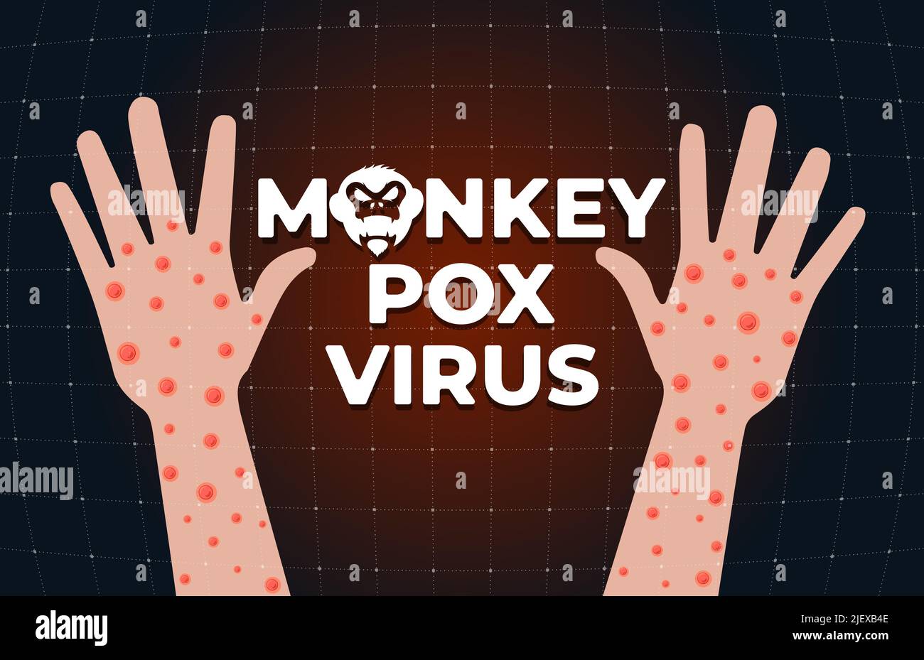 Monkeypox Virus infection on Hand Banner Konzept. Affenpocken-Krankheit Ausbruch Blasen und Ausschlag auf der Armhaut. MPV MPVX-Gefahr und epidemisches Risiko für die öffentliche Gesundheit. Pockenerkrankung Symptom. Vektor Stock Vektor