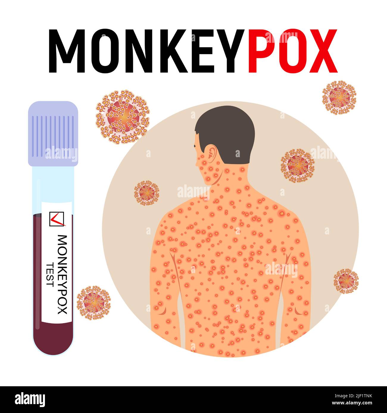 Monkeypox-Pandemieposter. Pockenmännchen, Reagenzglas mit Blut mit positivem Test und Viruszellen. Viruserkrankung. Vektorgrafik. Stock Vektor