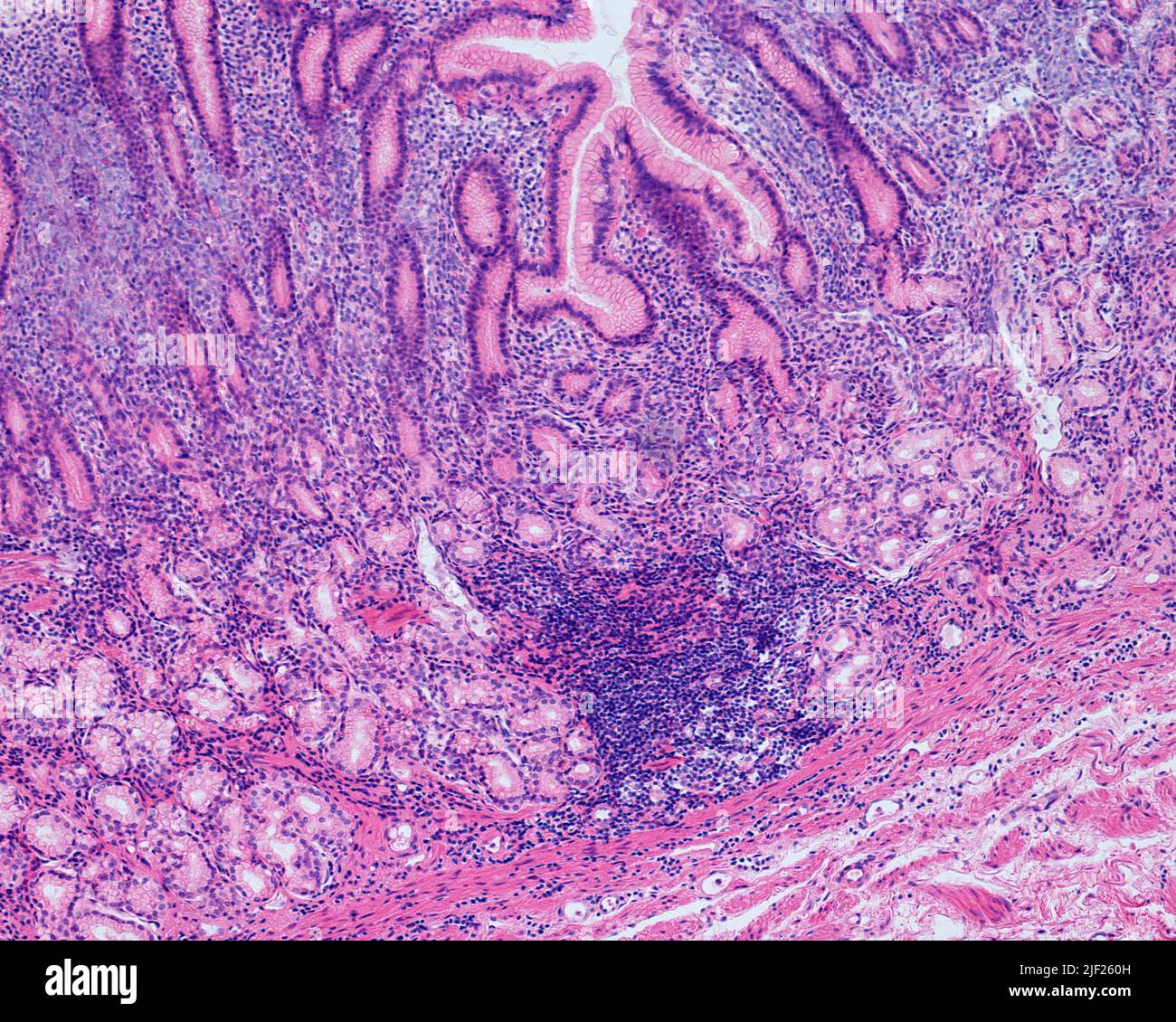 Chronische Gastritis. Leichte Mikrographik der menschlichen antralen