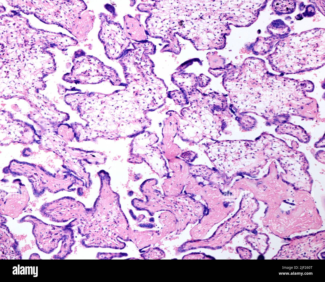 Menschliche Plazenta. Erythroblastose fetalis. Zu sehen ist ein