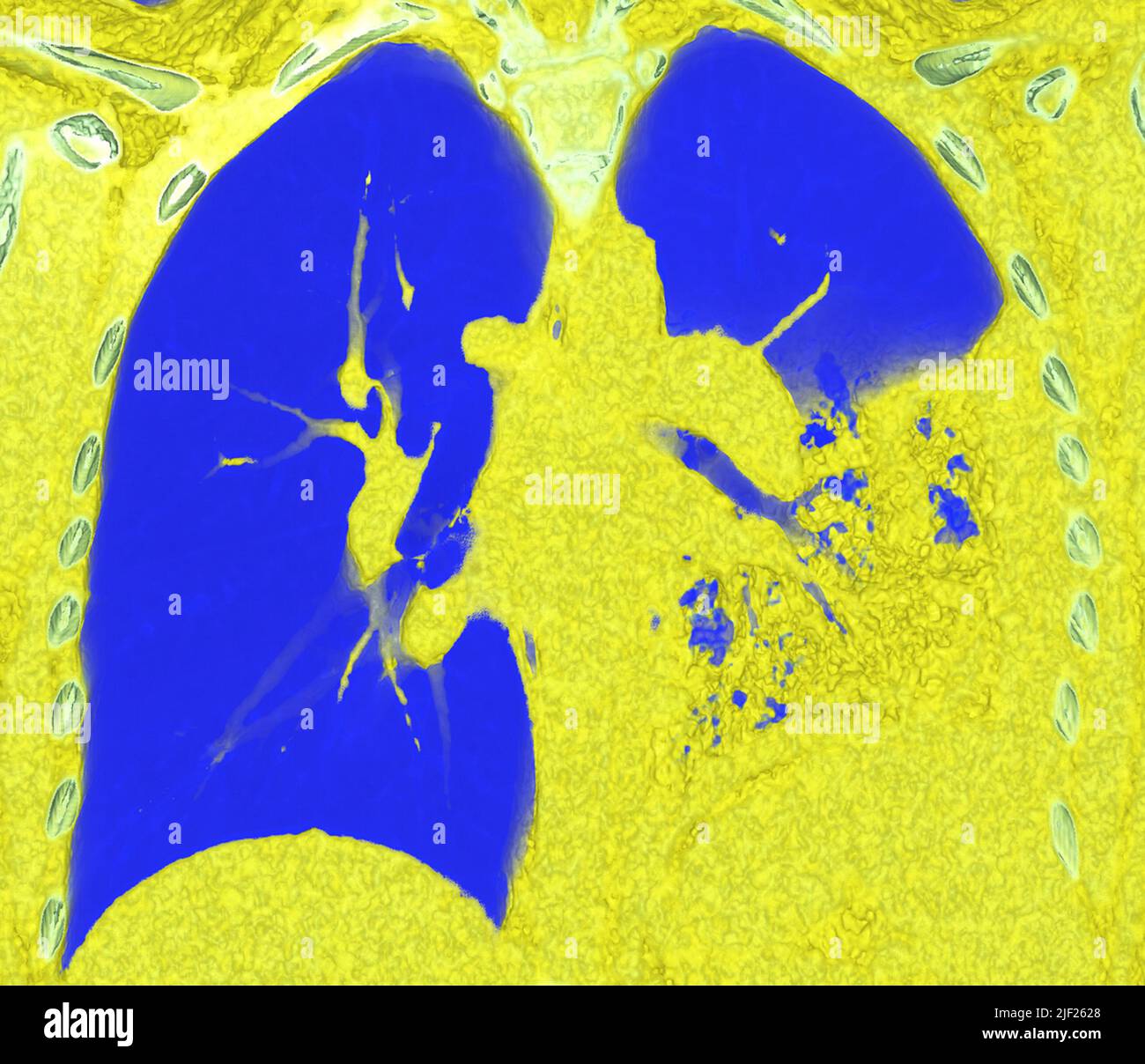 Farbige Computertomographie (CT) des Brustkorbs eines Patienten mit