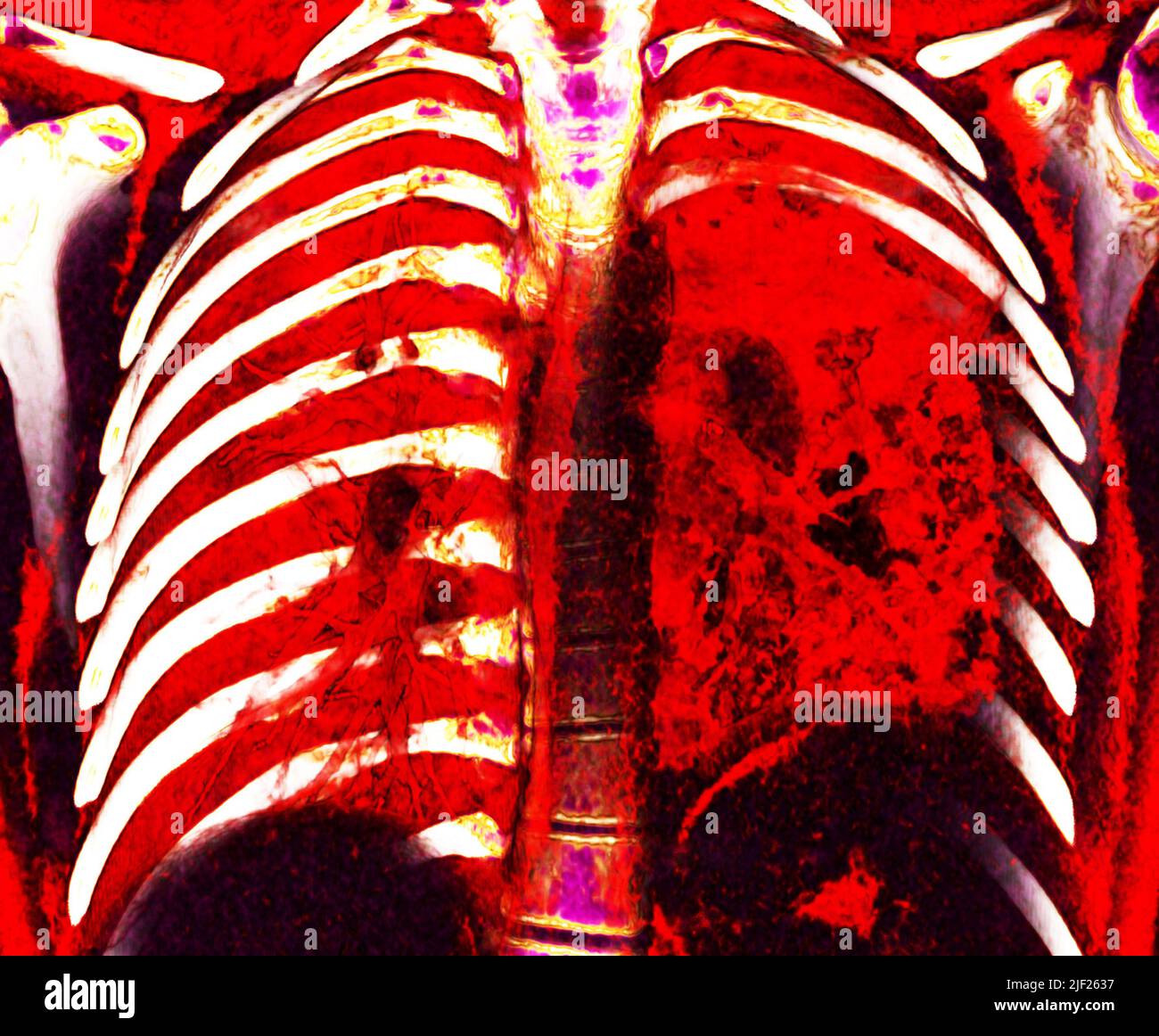 Farbige Computertomographie (CT) des Brustkorbs eines Patienten mit
