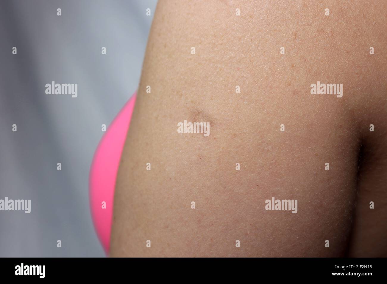 Eine Narbe aus einer Pockenimpfung ist am Oberarm einer reifen Frau sichtbar Stockfoto