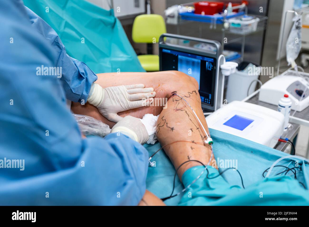 Krampfadern Chirurgie handeln, eine oberflächliche Venen Probleme, geschwollene Haut Stockfoto
