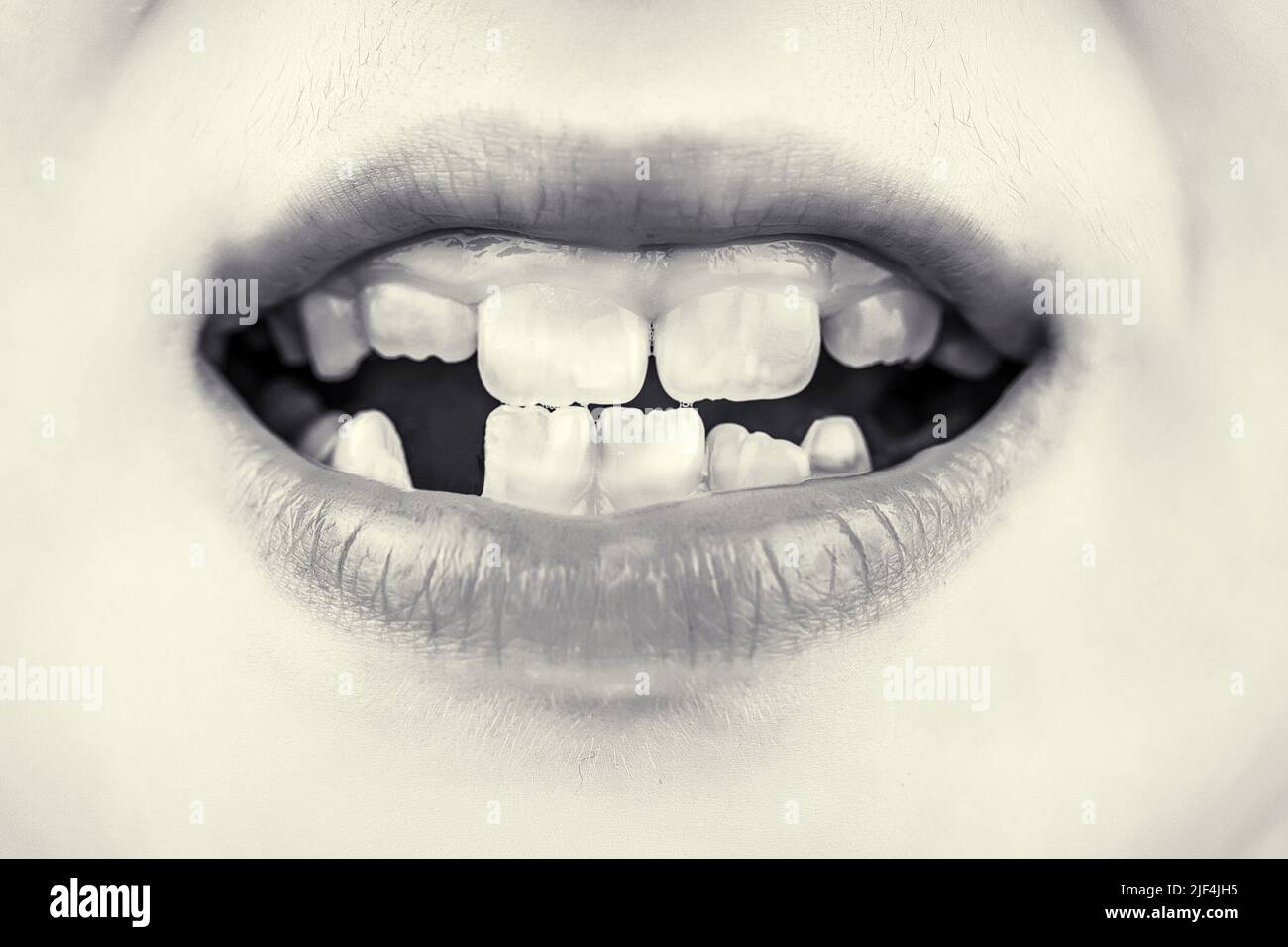 Kind mit schlechten Zähnen. Portrait Junge mit schlechten Zähnen. Kind lächelt und zeigt ihren