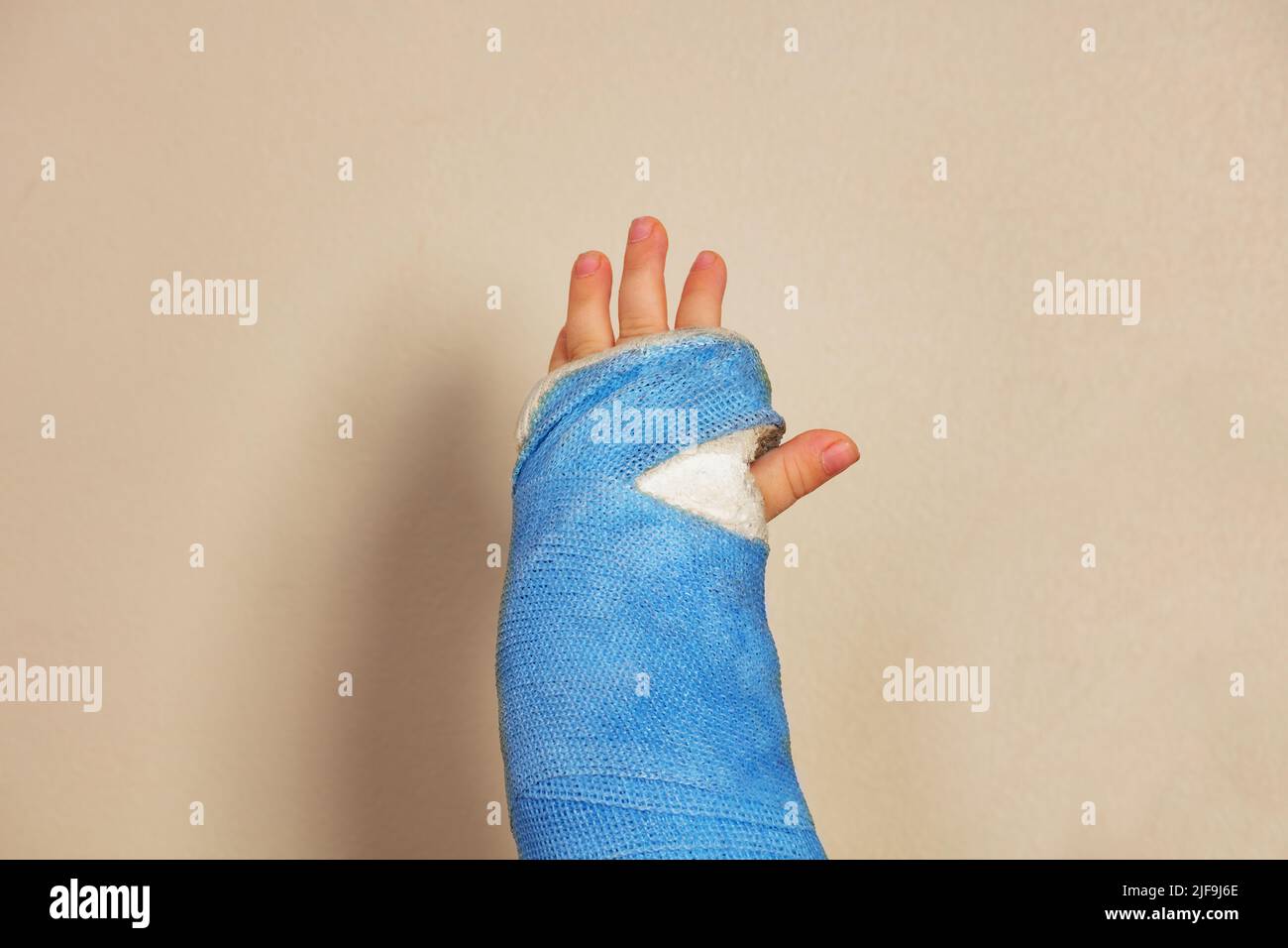 Gebrochene Hand blauer Gips nach Unfall auf die Handfläche konzentrieren Stockfoto