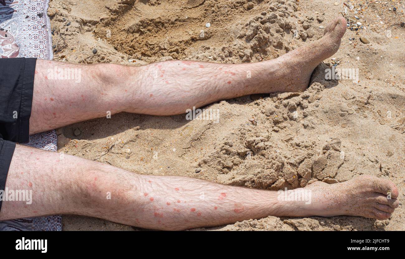 Ein sonnenverwöhnter Erwachsener liegt auf dem Sand mit blassen Beinen und roten Flecken von Psoriasis. Hauterkrankung mit Psoriasis-Geschwüren. Stockfoto