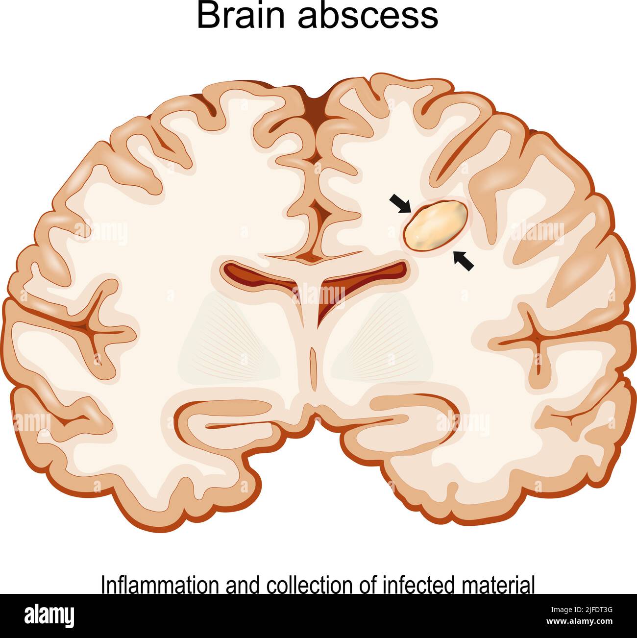 Hirnabszess. Zerebraler Abszess. Infektionskrankheiten des Gehirns. Querschnitt eines menschlichen Gehirns mit der intrazerebralen Eitersammlung. Vektorposter Stock Vektor