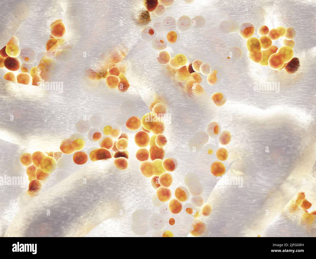 Kolonie von Staphylococcus aureus-Bakterien. Staphylokokken sind die häufigste Ursache von Biofilm-assoziierten Infektionen. Nosokomiale Infektionen Konzept Stockfoto