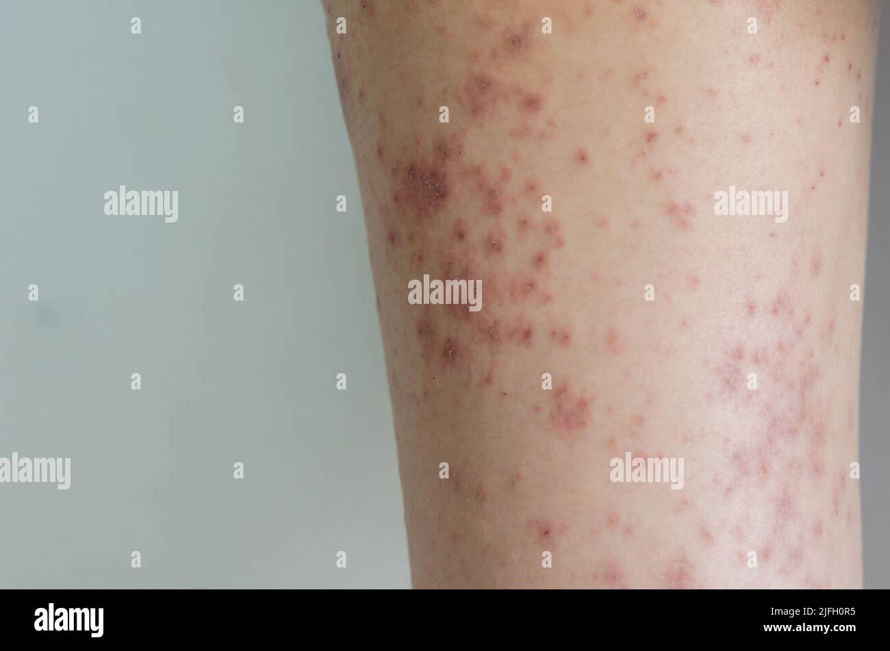 Rote Hautausschlag Mdchen Hauterkrankung durch Allergien auf Medikamente,  Lebensmittel, Chemikalien, schlechtes Immunsystem in der Lymphe verursacht  Stockfotografie - Alamy