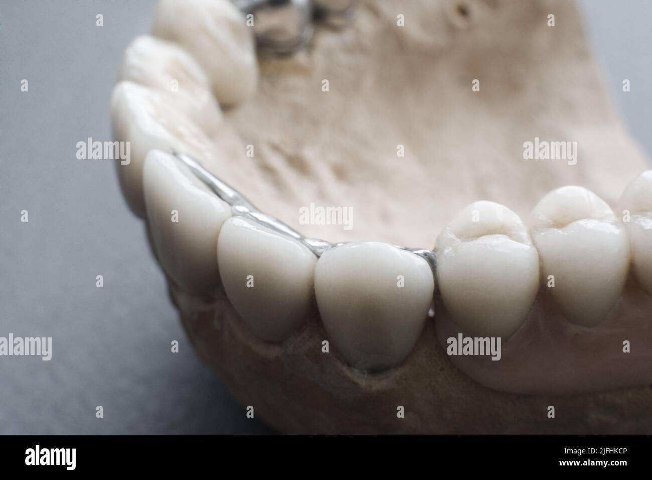 Keramische Zahnimplantate auf Gips layout close-up Stockfoto