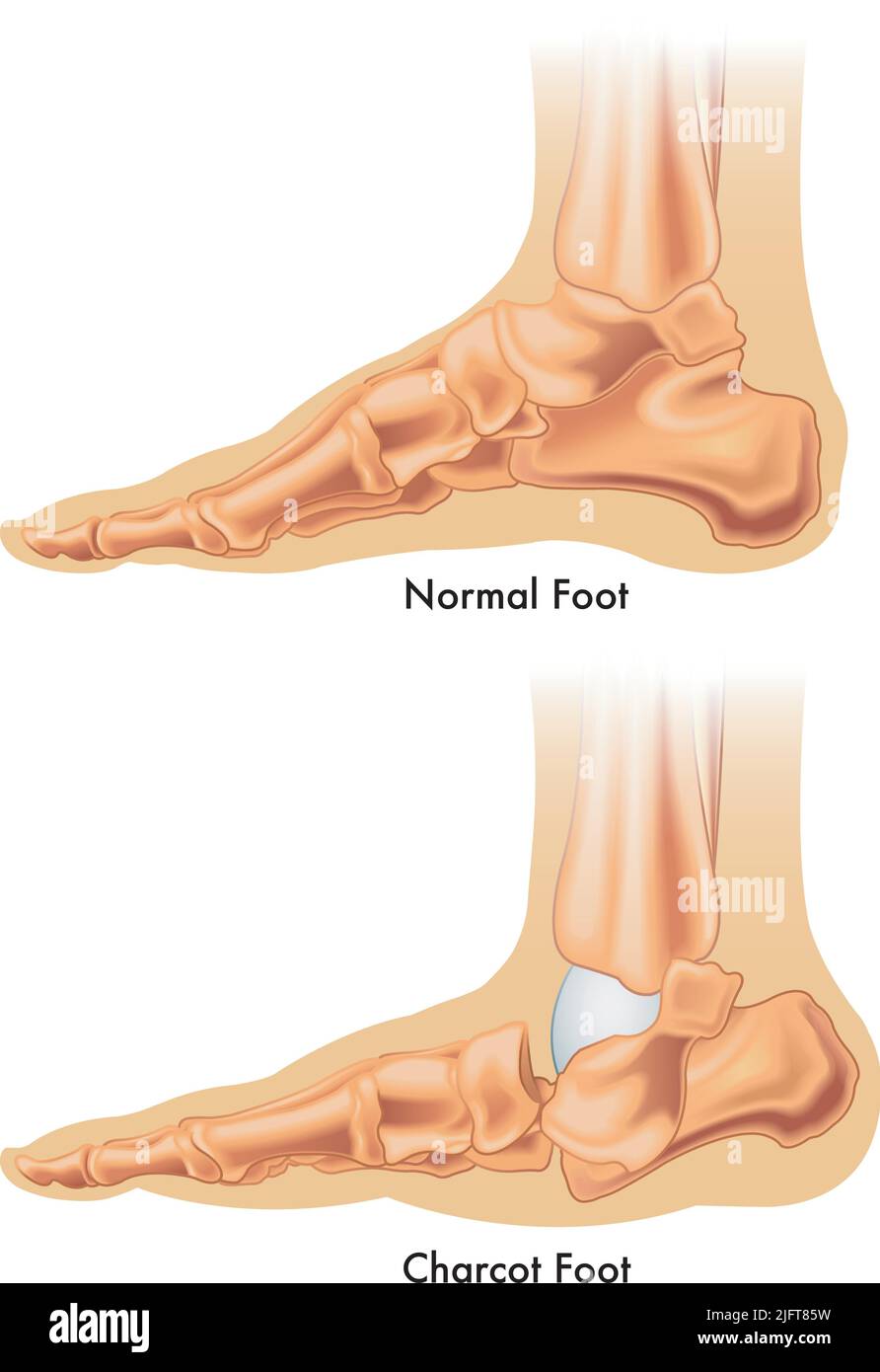 Die medizinische Abbildung zeigt den Unterschied zwischen einem normalen Fuß und einem charcot-Fuß. Stock Vektor