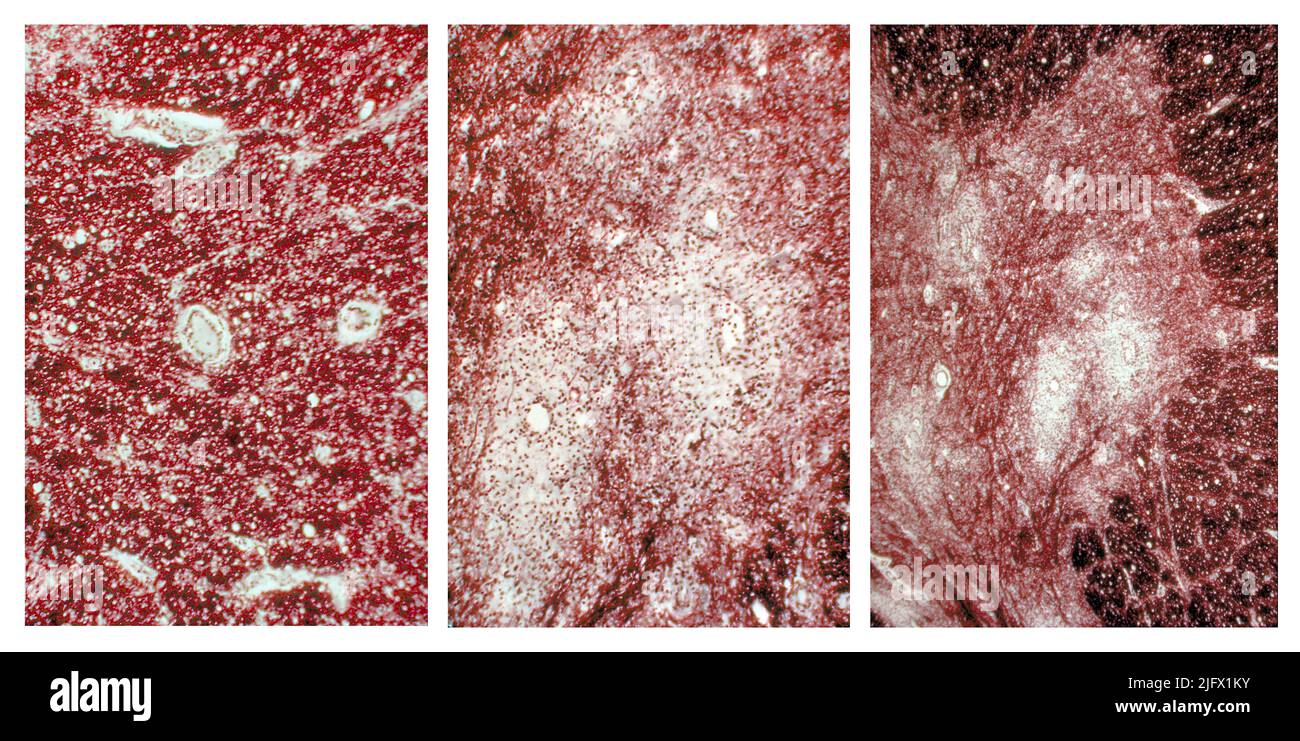 Drei Photomikrographen des zervikalen Rückenmarks im Bereich des vorderen Horns zeigen degenerative Veränderungen des Polio Typ III. Das Poliovirus hat eine Affinität zu den anterioren hornmotorischen Neuronen der zervikalen und lumbalen Regionen des Rückenmarks. Der Tod dieser Zellen verursacht Muskelschwäche dieser Muskeln, die einst von den jetzt toten Neuronen innerviert wurden. Digital koloriertes /Falschfarbenbild. Optimierte und verbesserte Versionen von Bildern, die von den US Centers for Disease Control and Prevention / Credit CDC /Dr.Karp erstellt wurden Stockfoto