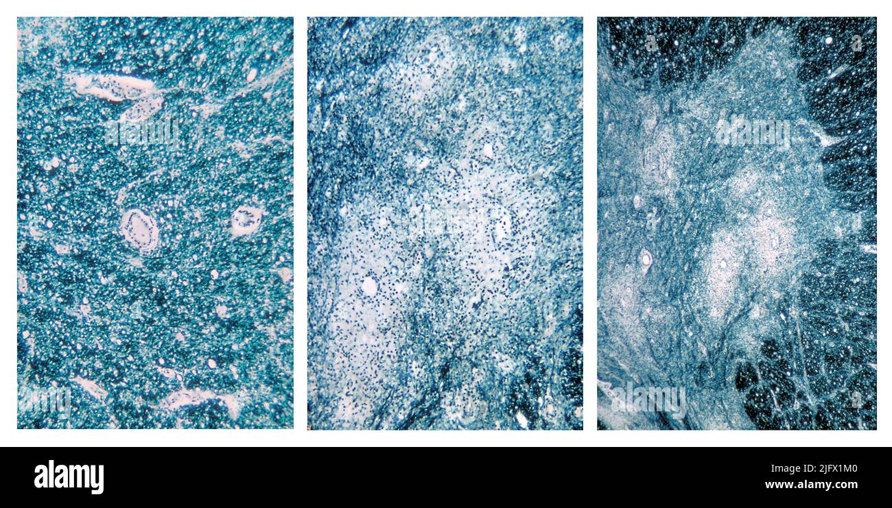 Drei Photomikrographen des zervikalen Rückenmarks im Bereich des vorderen Horns zeigen degenerative Veränderungen des Polio Typ III. Das Poliovirus hat eine Affinität zu den anterioren hornmotorischen Neuronen der zervikalen und lumbalen Regionen des Rückenmarks. Der Tod dieser Zellen verursacht Muskelschwäche dieser Muskeln, die einst von den jetzt toten Neuronen innerviert wurden. Optimierte und verbesserte Versionen von Bildern, die von den US Centers for Disease Control and Prevention / Credit CDC /Dr.Karp erstellt wurden Stockfoto