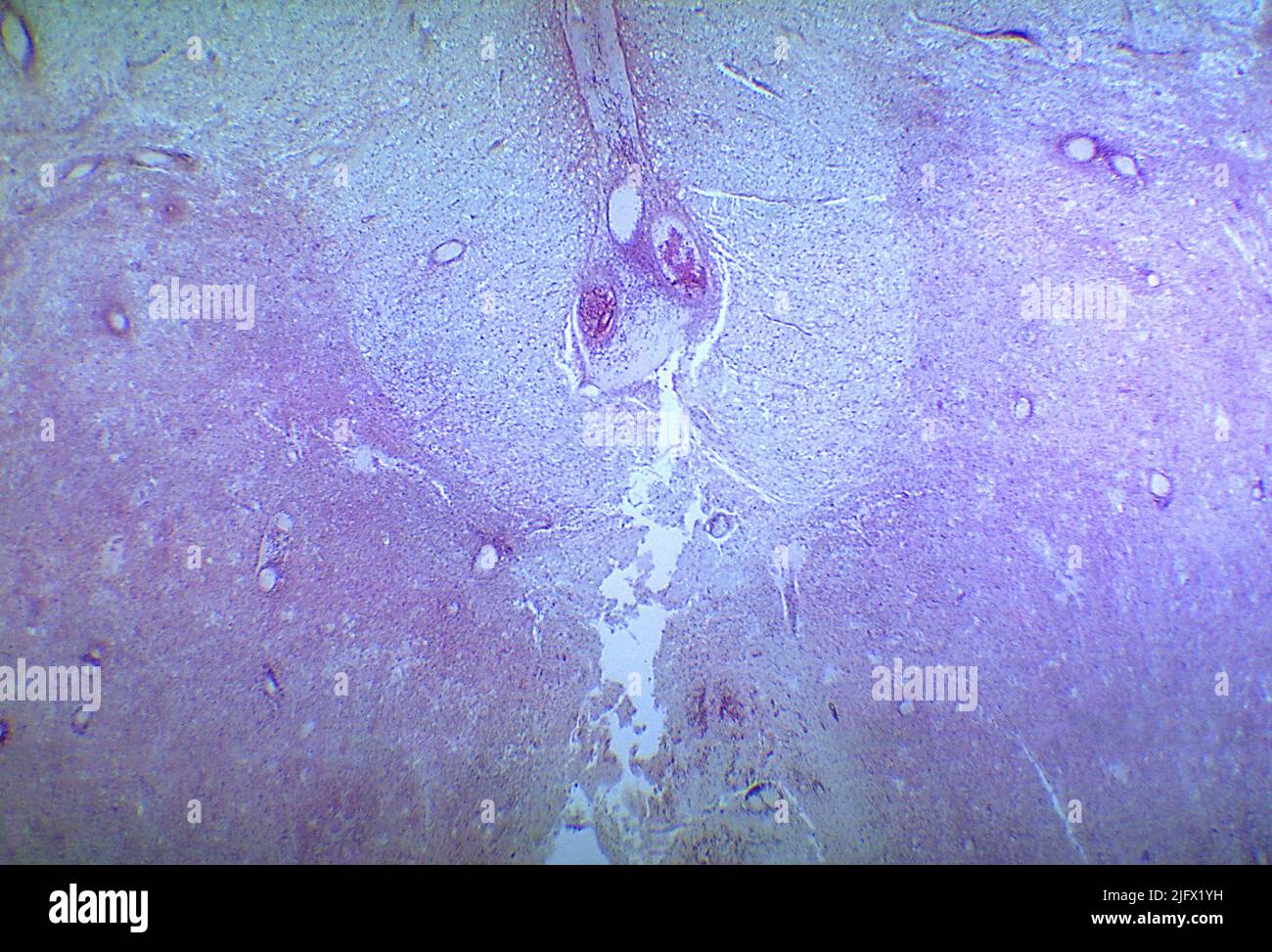 Ein Photomikrograph des lumbalen Rückenmarks, der degenerative Veränderungen aufgrund eines Infarkts darstellt, der durch Polio Typ III verursacht wurde Wenn die Neuronen der Wirbelsäule selbst sterben, kommt es zu einer wallerischen Degeneration, die zu einer Muskelschwäche dieser Muskeln führt, die einst von den jetzt toten Neuronen (denerviert) innerviert wurden. Der Grad der Lähmung ist direkt mit der Anzahl der verstorbenen Neuronen korreliert. Eine optimierte und verbesserte Version eines Bildes, das von den US Centers for Disease Control and Prevention / Credit CDC /Dr.Karp erstellt wurde Stockfoto