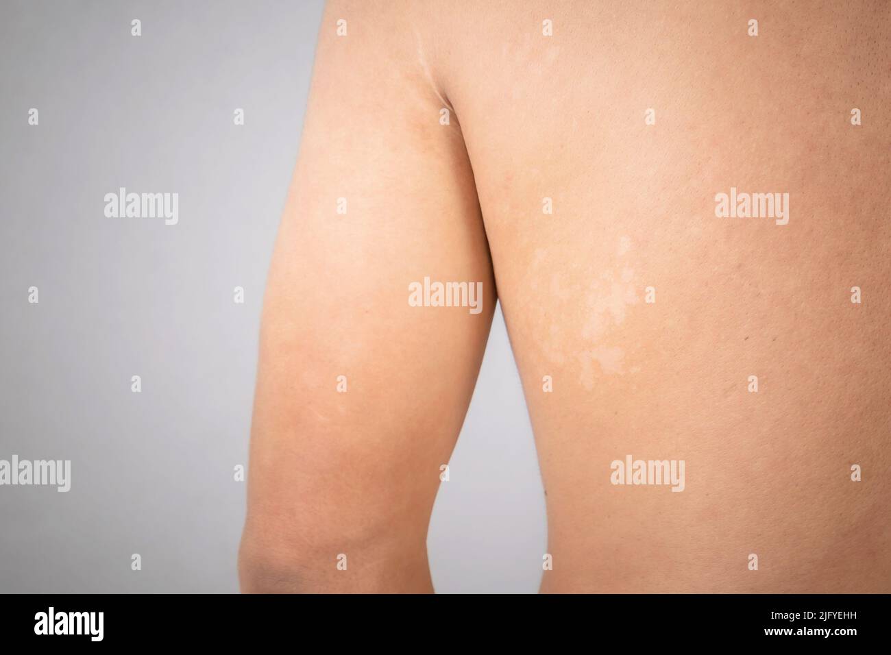 Gesundheitswesen : Makroweiße Pityriasis oder Tinea Versicolor auf der Rückenhaut. Hautpflegekonzept Stockfoto