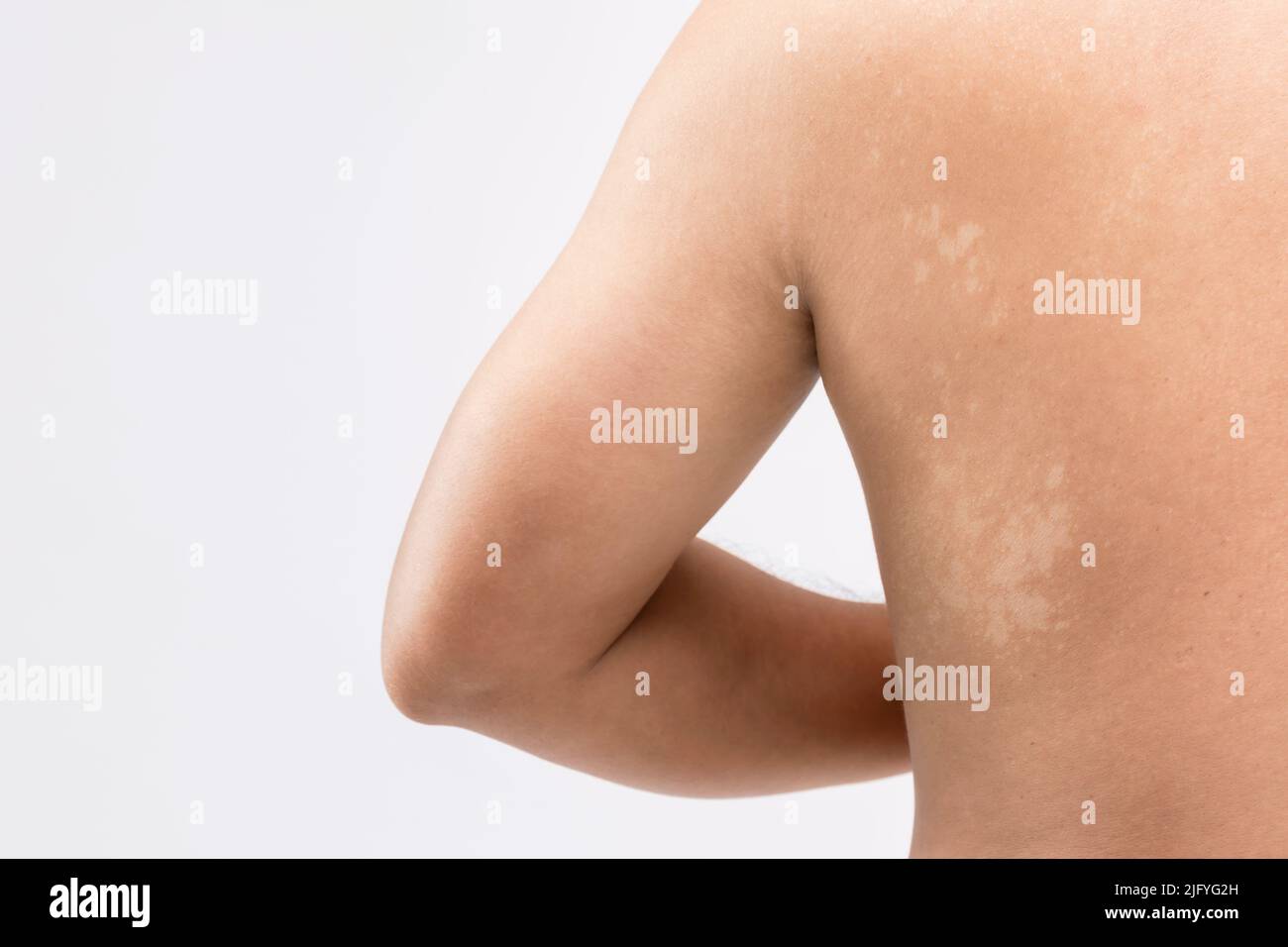Gesundheitskonzept: Makrorweisse Pityriasis oder Tinea Versicolor auf der Rückenhaut. Wird für das Hautpflegekonzept verwendet Stockfoto