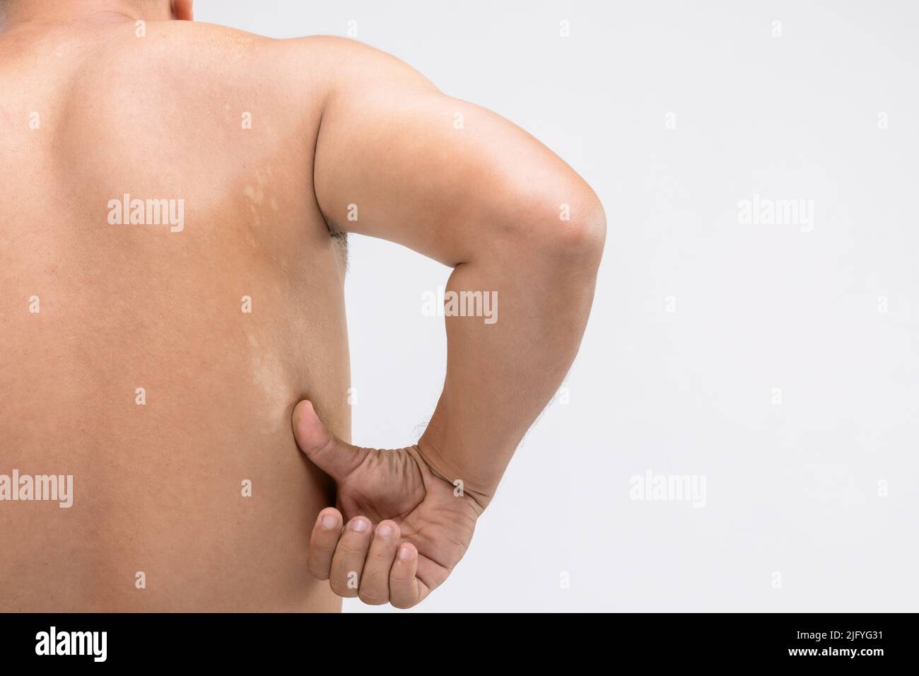 Gesundheitskonzept: Makrorweisse Pityriasis oder Tinea Versicolor auf der Rückenhaut. Wird für das Hautpflegekonzept verwendet Stockfoto