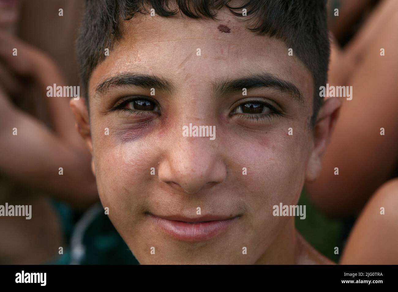 Kırkpınar (Türkisches Ölwrestling). Junger Wrestler mit einem schwarzen Auge, abgebildet während des Kırkpınar-Turniers 648. in Edirne, Türkei, am 3. Juli 2009. Stockfoto
