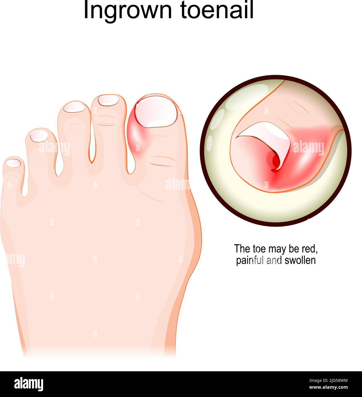 Eingewachsene Zehennagel. Menschlicher Fuß. Nahaufnahme von roten, schmerzhaften und geschwollenen Zehen. vektordarstellung Stock Vektor