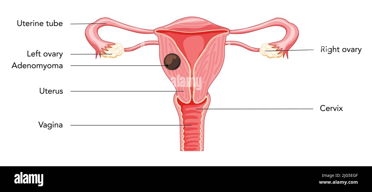 Adenomyom Adenomyose mit Inschriften, menschliche Anatomie weibliche reproduktive Krankensystemorgane. Struktur von Gebärmutter, Gebärmutterhals, Eierstock, Eileiter im lateinischen Text. Frontalansicht Vektordarstellung Stock Vektor