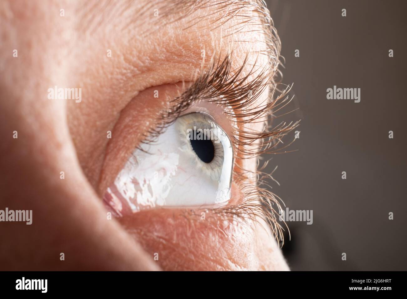 Keratokonus Augenaufnahme , Verdünnung der Hornhaut. Stockfoto