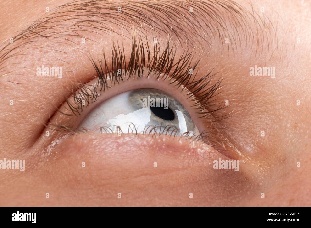 Weibliches Auge mit Keratokonus kornealer Verdünnung diagnostiziert. Stockfoto