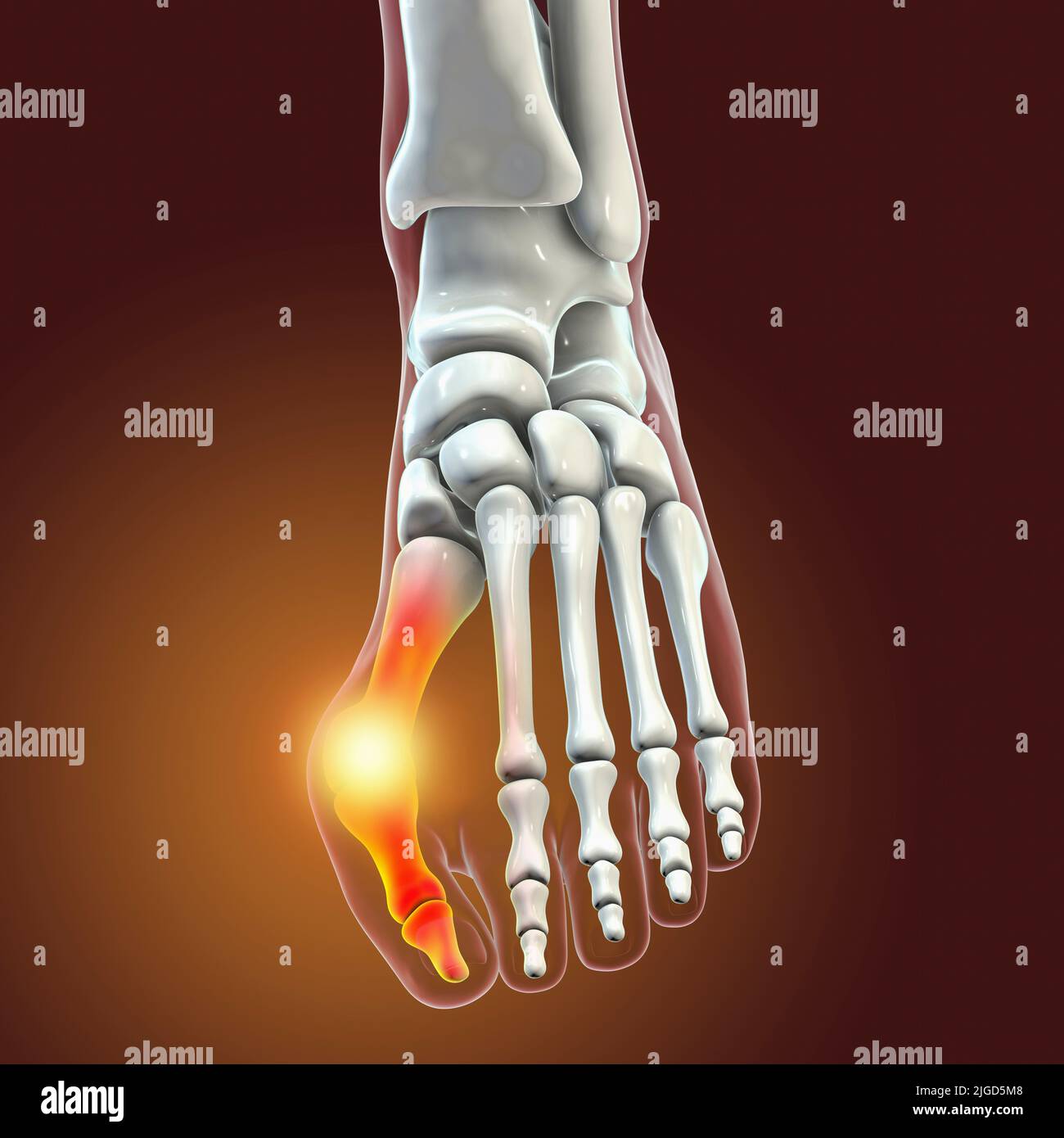 Bunion, Illustration Stockfoto