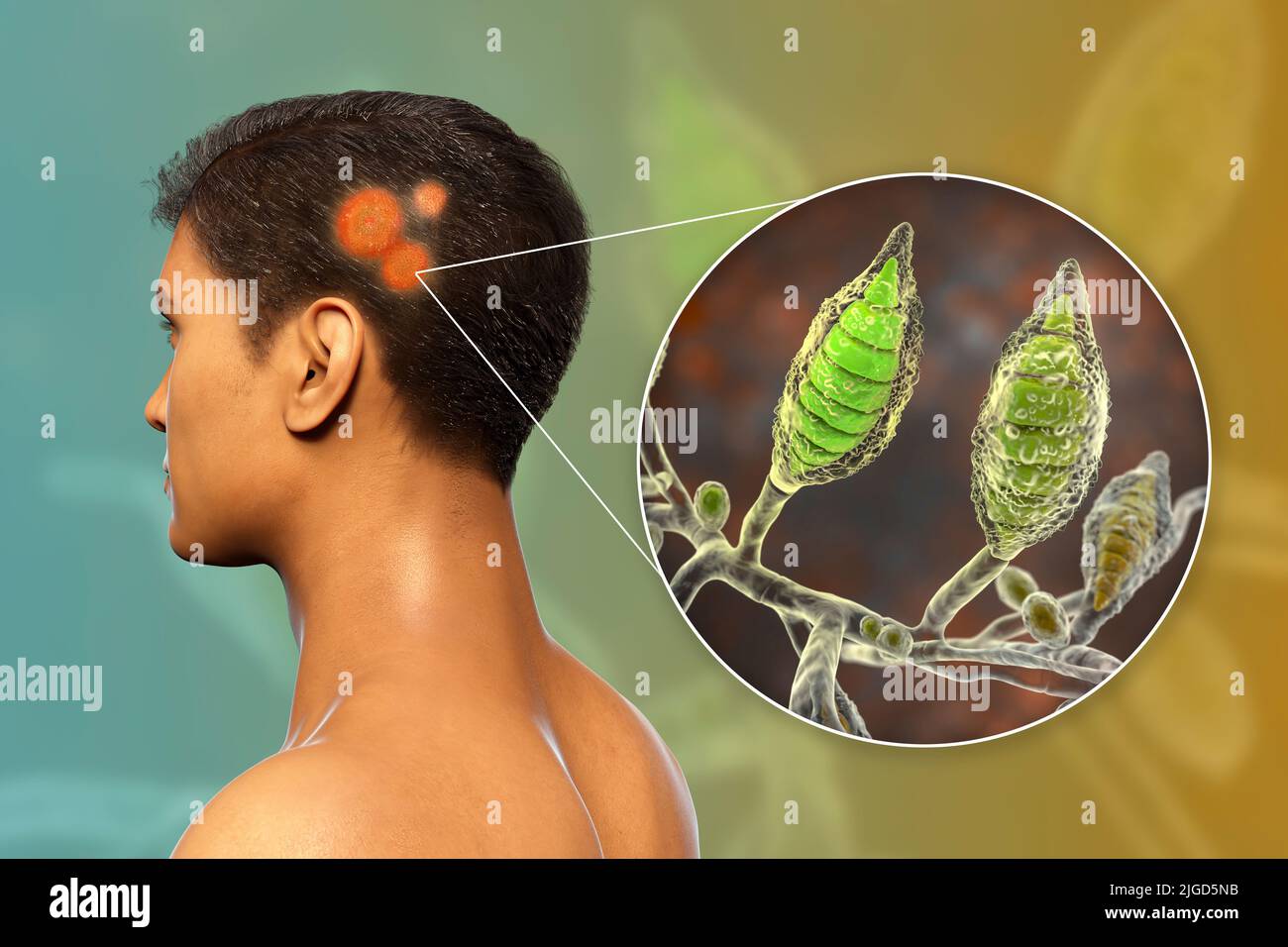 Ringwurm, Abbildung Stockfoto