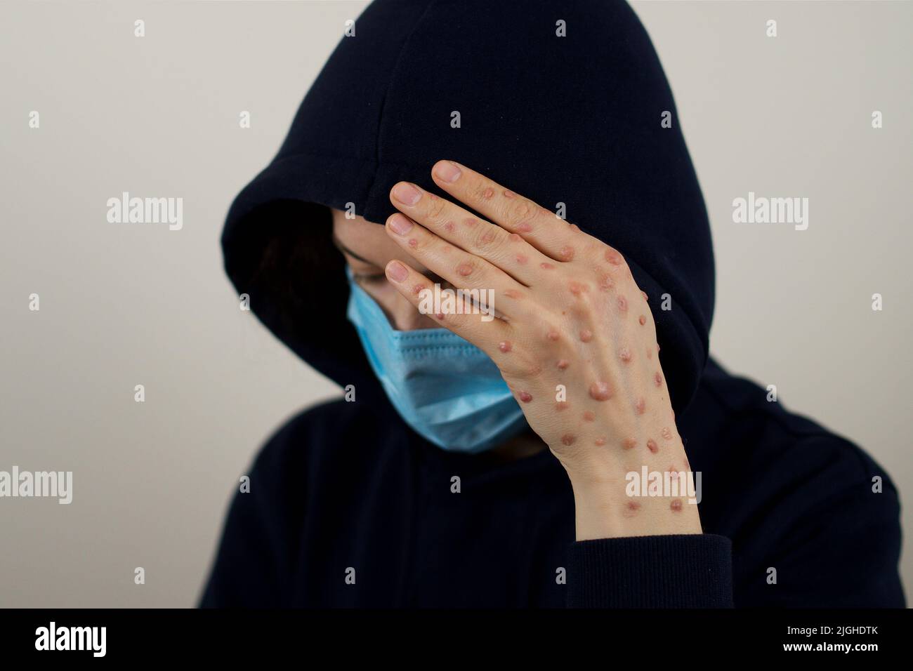 Eine Frau, die sich mit einem Blasenausschlag infiziert hat und ihr Gesicht versteckt Stockfoto