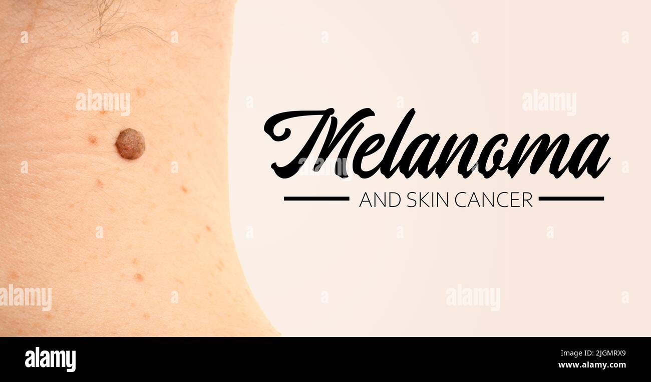 Haut mit Muttermalen und TEXTMELANOM UND HAUTKREBS auf hellem Hintergrund Stockfoto