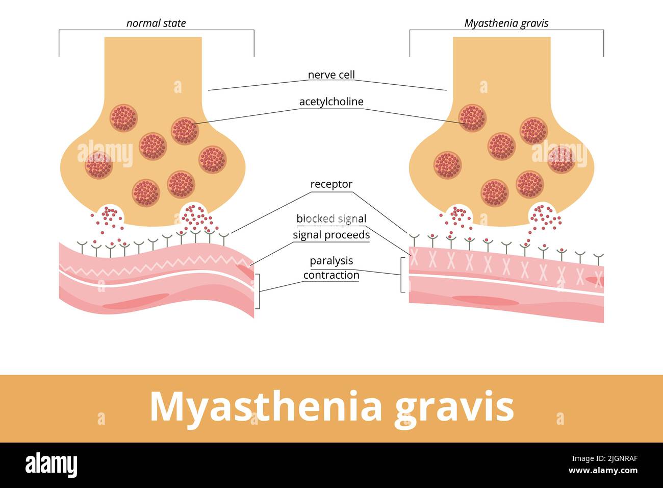 Myasthenia gravis. Eine Autoimmunerkrankung der neuromuskulären Kreuzung, wenn Antikörper Nikotinacetylcholin-Rezeptoren (ACHR) blockieren oder zerstören Stock Vektor
