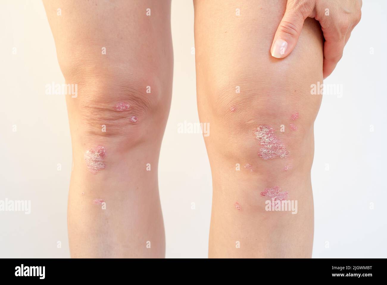 Psoriatische Arthritis mit Psoriasis auf den Knien einer Frau. Entzündliche Arthritis verursacht Schwellungen, Steifheit, Rötung, Schmerzen und Gelenkschäden Stockfoto
