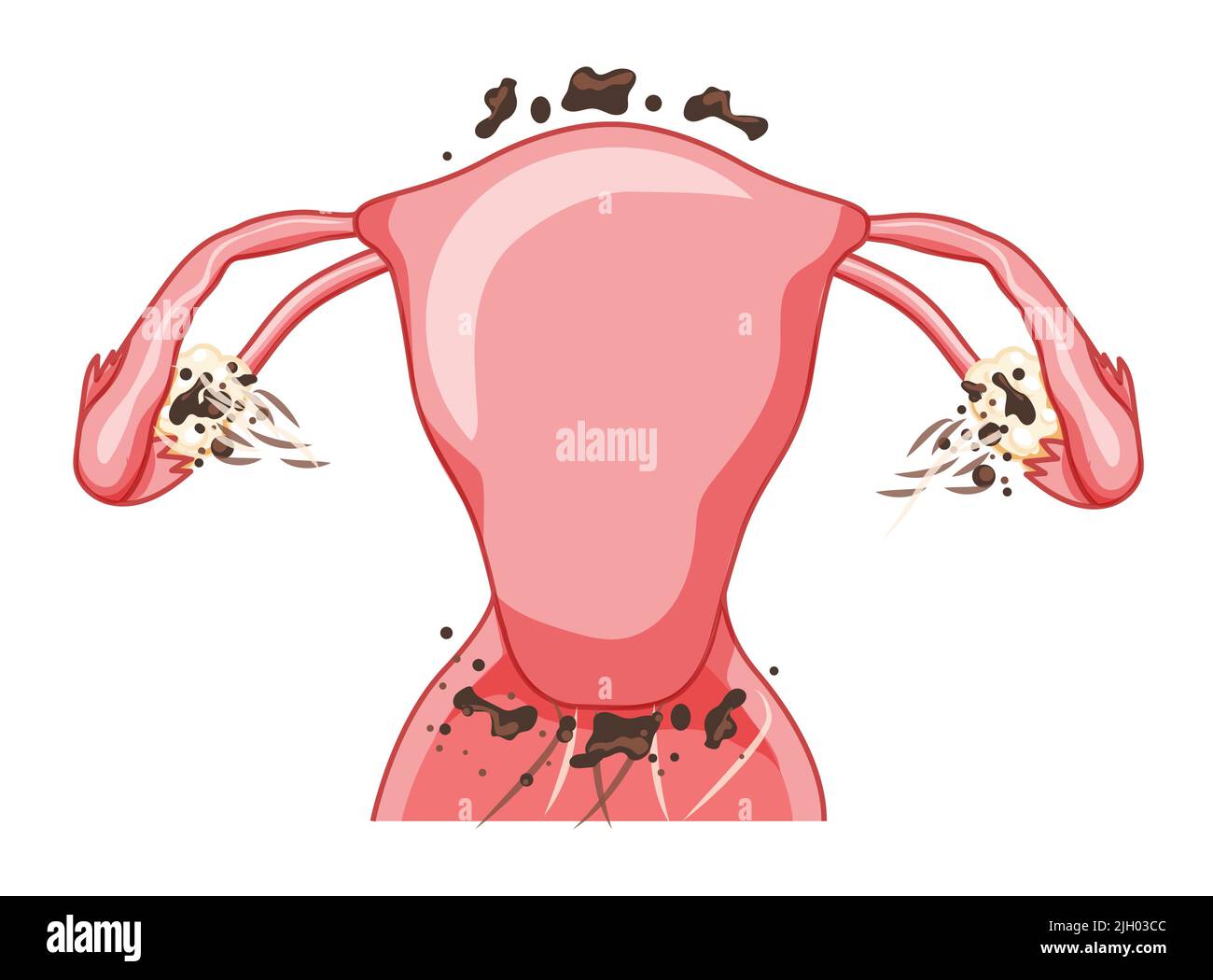 Endometriose 3 Stadium Weibliches Fortpflanzungssystem Vorderansicht. Menschliche Anatomie
