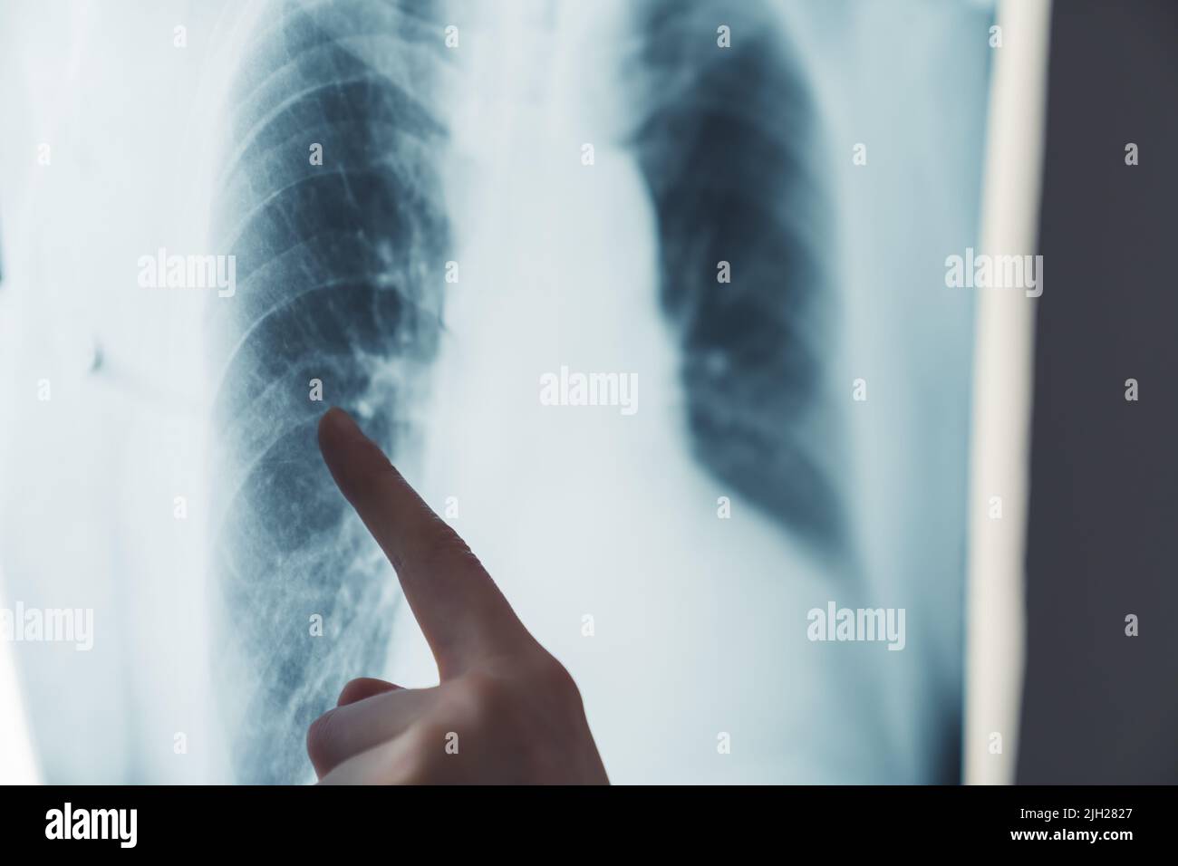 Beleuchteter Röntgenstrahl der Lunge und ein Finger, der auf den Rippenbereich zeigt. Verletzte Patientin beschwert sich über Brustschmerzen. Hochwertige Fotos Stockfoto