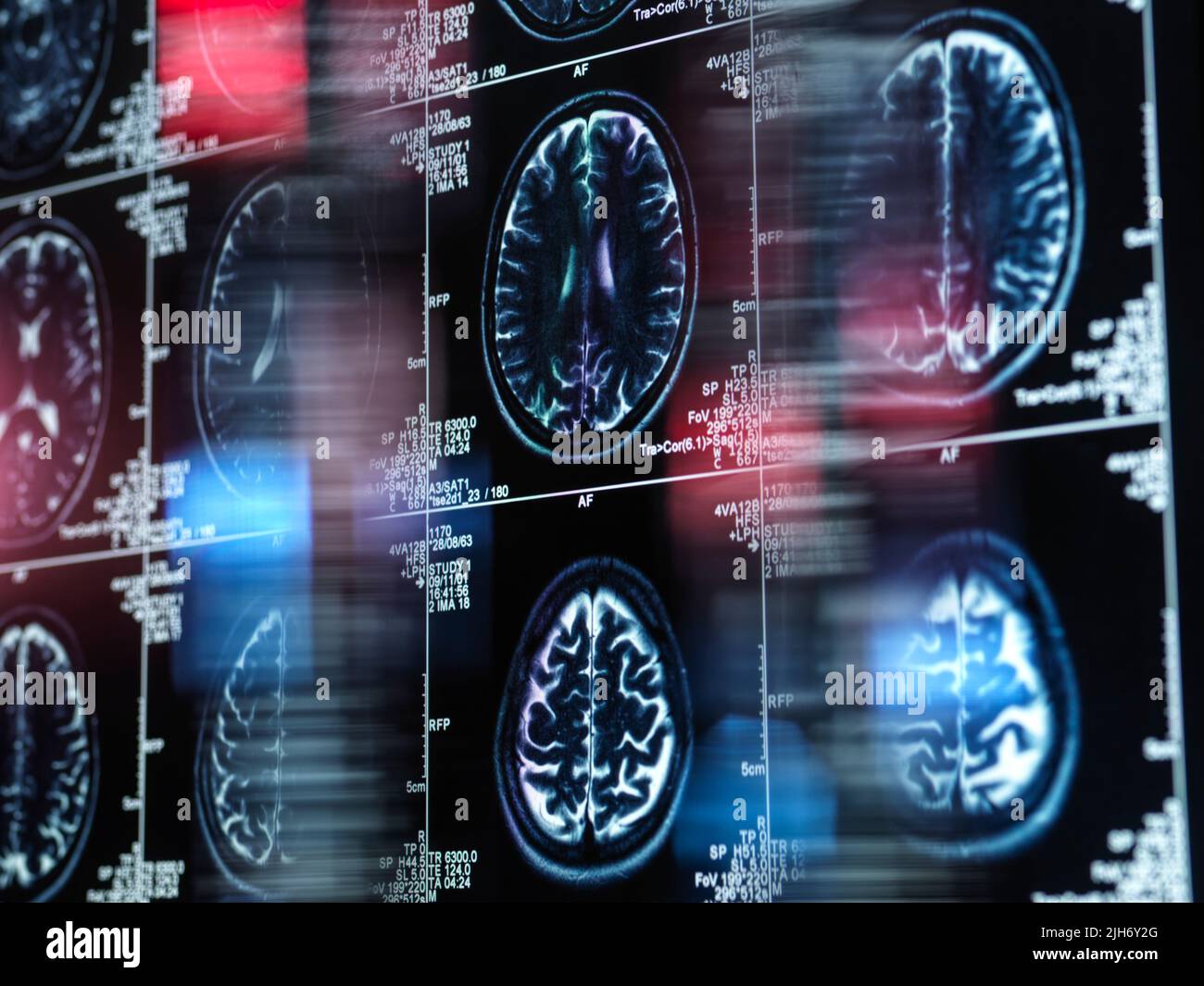 Alzheimer- und Demenzforschung, konzeptuelles Bild Stockfoto