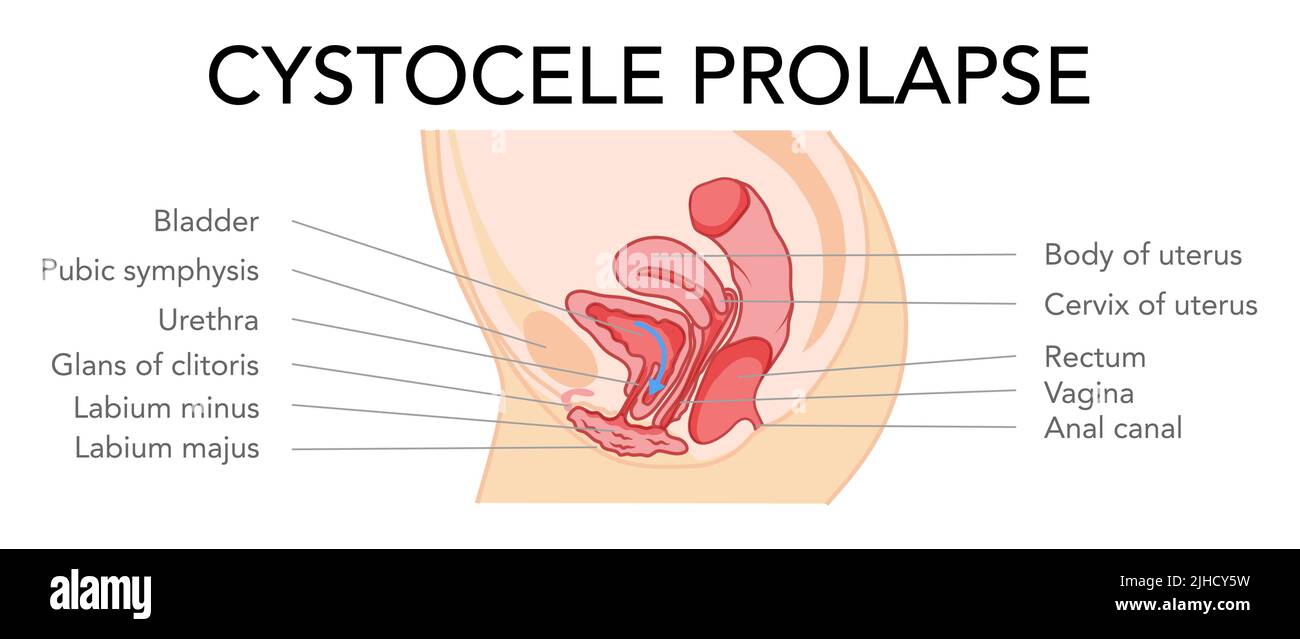 Prolaps cystocele Weibliche Fortpflanzungssystem uterus mit Inschriften