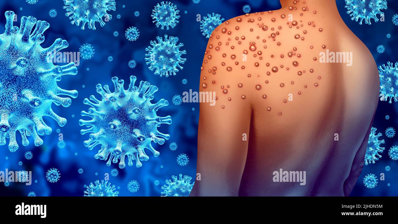 Der Ausbruch des Monkeypox- oder Monkey Pox-Virus als ansteckende Infektion als Blasen und Hautläsionen, die die Übertragung einer infizierten Person darstellen Stockfoto