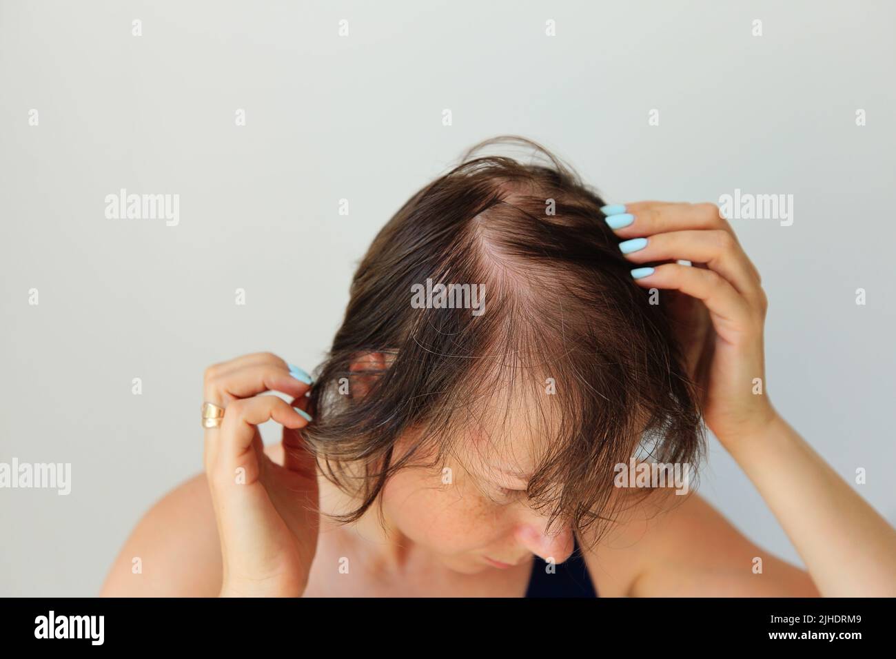 Haarausfall in Form von Alopecia areata. Kahlköpfiger Kopf einer Frau. Haarausfall nach Covid. Kahle Stellen mit totaler Alopezie Stockfoto