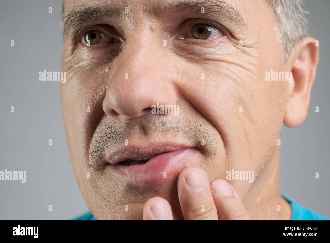 Allergische Reaktion auf die Lippe eines Mannes nach einem Bienenstich Stockfoto