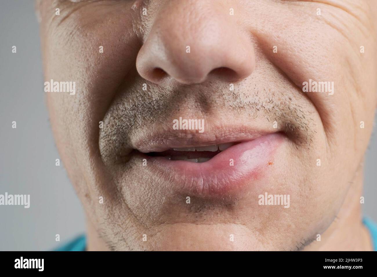 Allergische Reaktion auf die Lippe eines Mannes nach einem Bienenstich Stockfoto