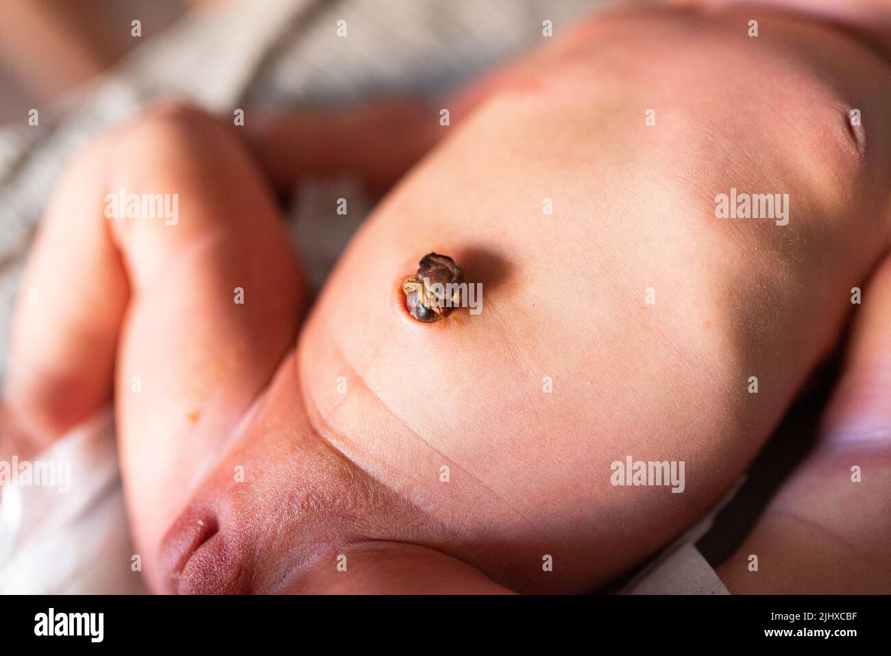 Neugeborenes Baby Bauchnabel Heilung nach der Geburt, Nabel des kleinen Babybauch Stockfoto