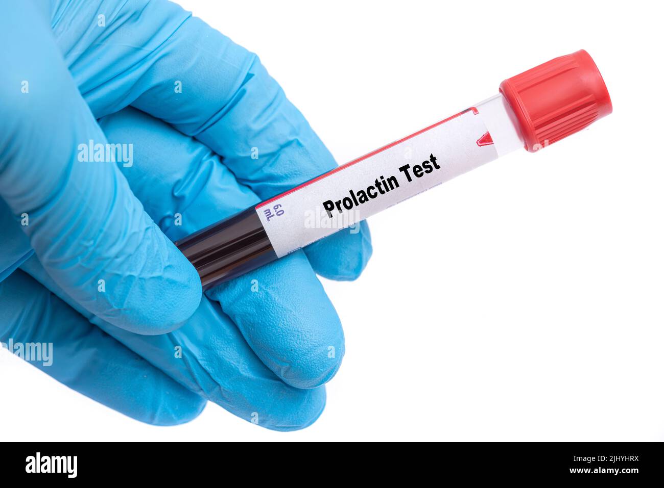 Prolaktin-Test Medizinisches Kontrollröhrchen mit biologischer Probe Stockfoto